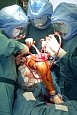 Chirurgen im OP - Einsetzen einer Kniegelenkprothese
